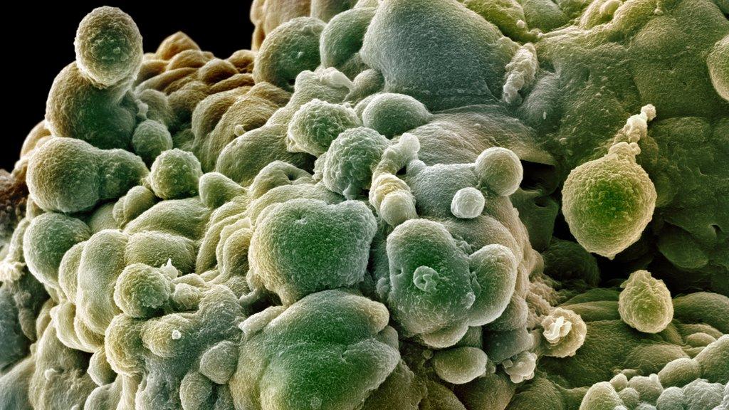 prostate cancer cells