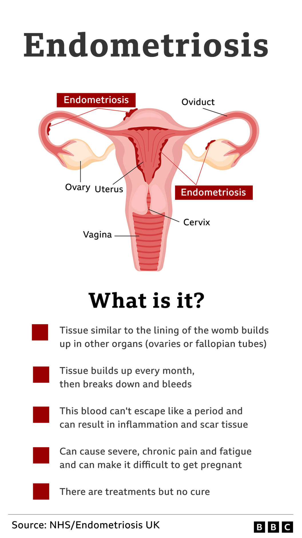 Endometriosis graphic showing a picture of a woman's anatomy, with the oviduct, ovaries, uterus, cervix and vagina marked, as well as where the endometriosis grows.