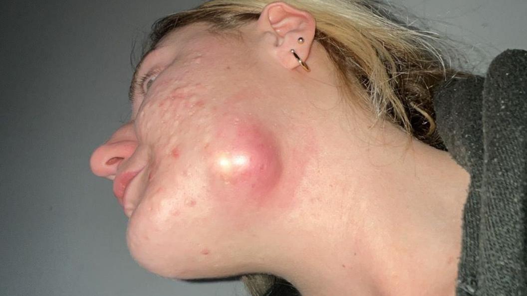 Picture of an inflamed cyst on Ashlee Crumpton's jawline 