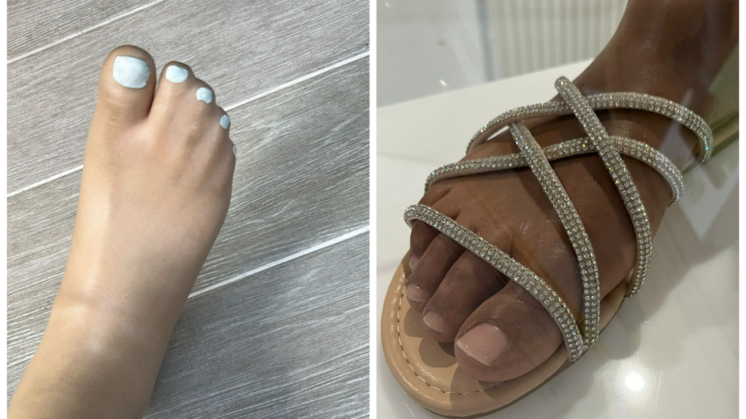 Side by side images of a prosthetic foot with a separate big toe and four joined-up smaller toes, and a prosthetic foot with five separate toes in a sandal