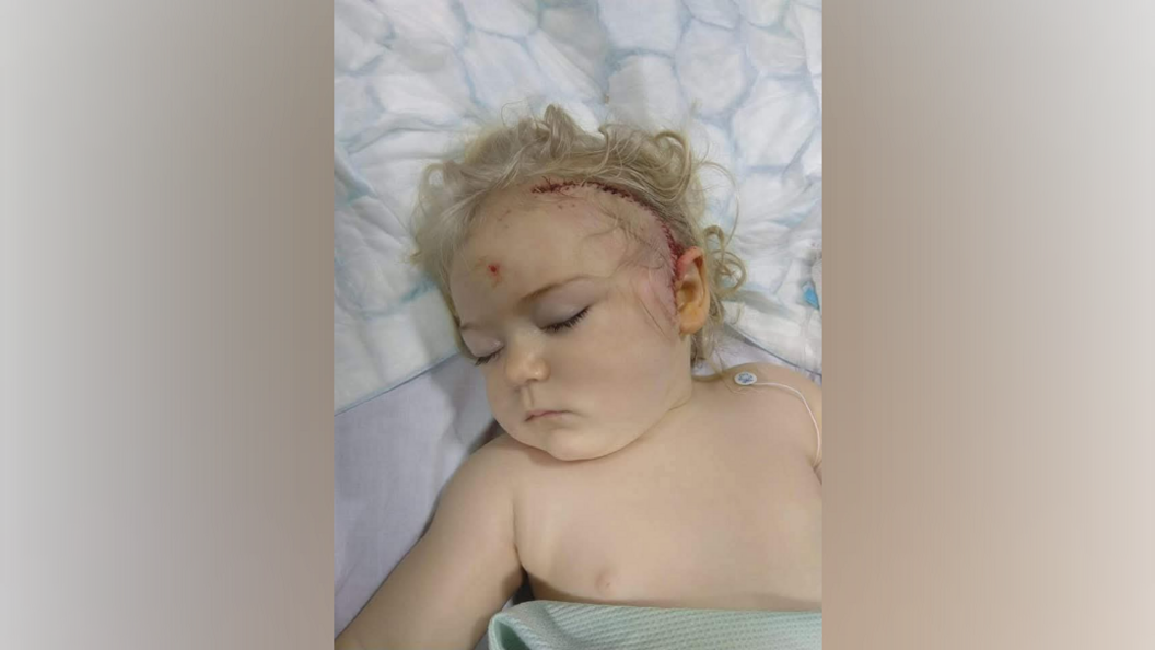 A young toddler girl, is sleeping on a hospital bed. A large scar can be seen on the side of her head.