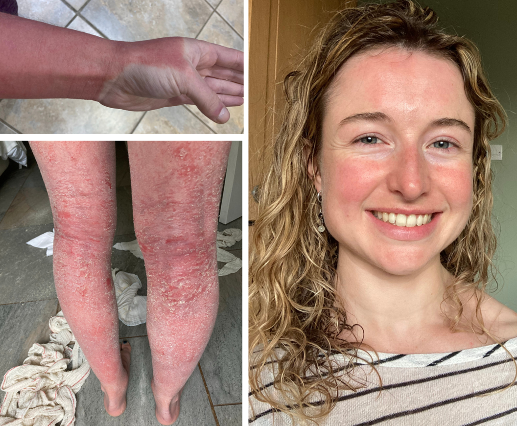 On the left are two images of Jenna Crosbie's legs and arms which are severely red, blistering and her skin is flaking off. On the right her skin looks healthier and she is smiling