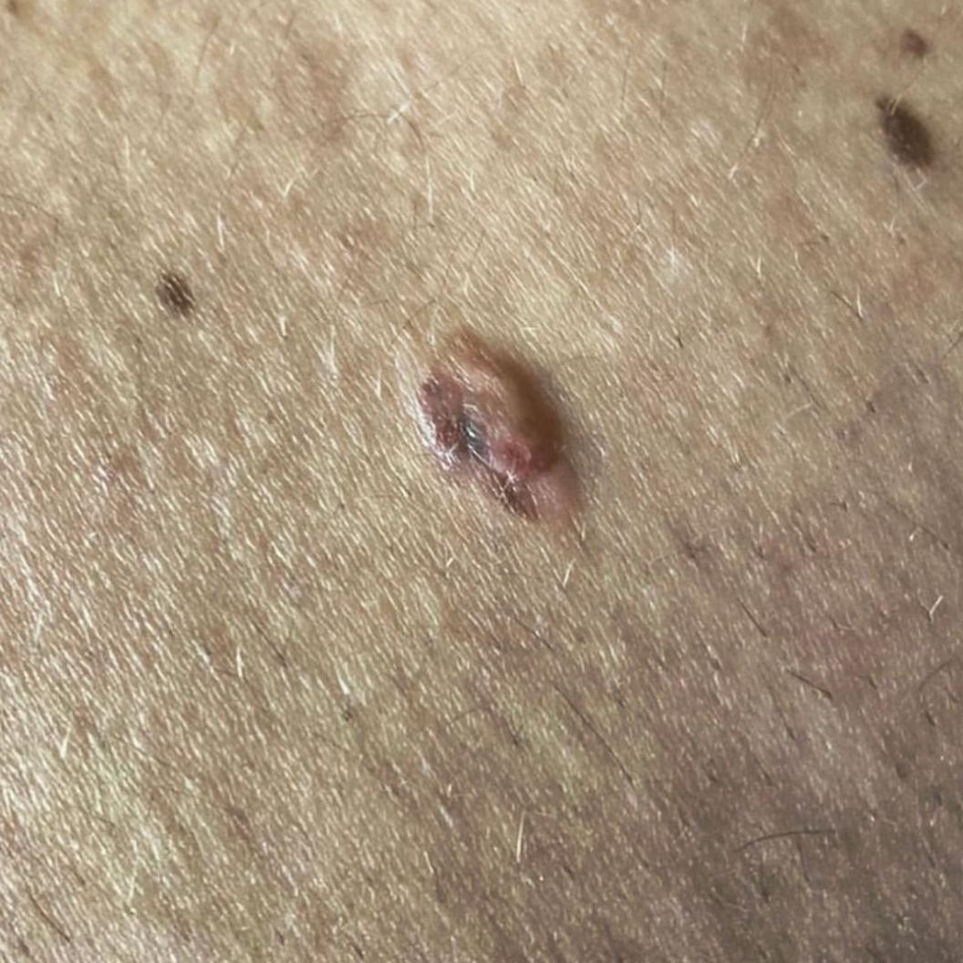 Jak Howells's melanoma found on his back