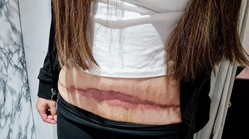 A woman shows a deep, dark pink scar that stretches across her stomach. She is wearing a white shirt and black leggings.