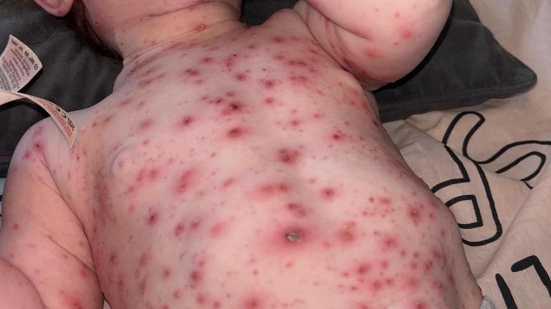 Mia's chickenpox rash was red, painful, itchy and blistering