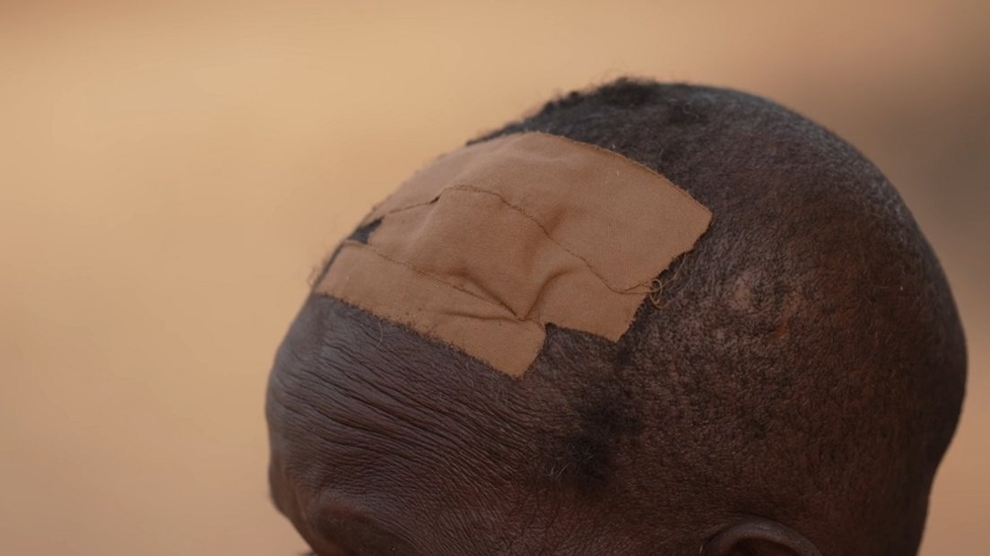 A close up of the top of someone's head with a large plaster clearly see on the top.