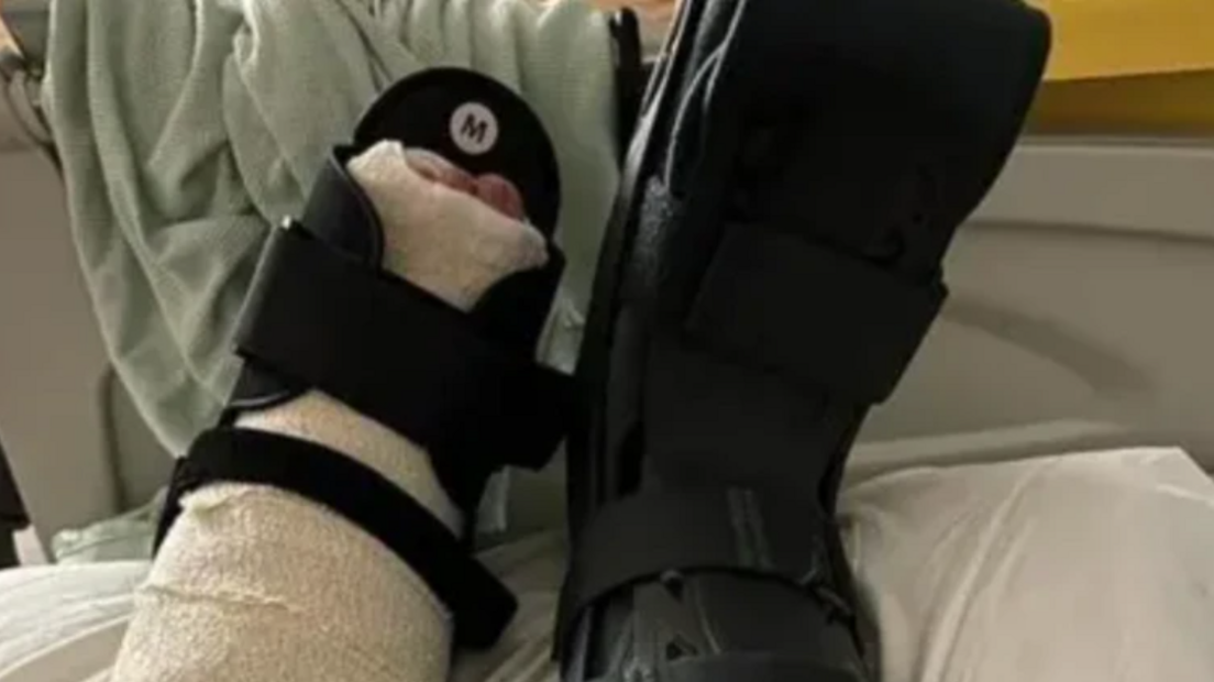 A broken ankle wrapped in white bandages and in a black boot
