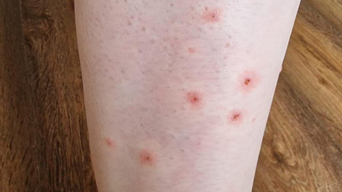 The photo shows the bottom of Alison's leg. There are 7 red marks that look like bites, which have scabbed over.