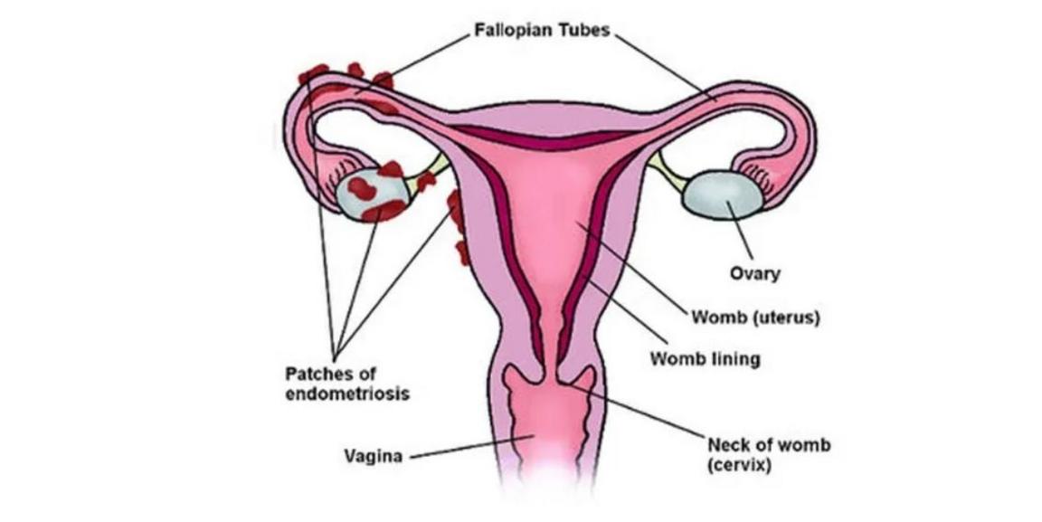 A diagram of the female reproductive organ with labels to each section and red blotches on the fallopian tubes and ovaries