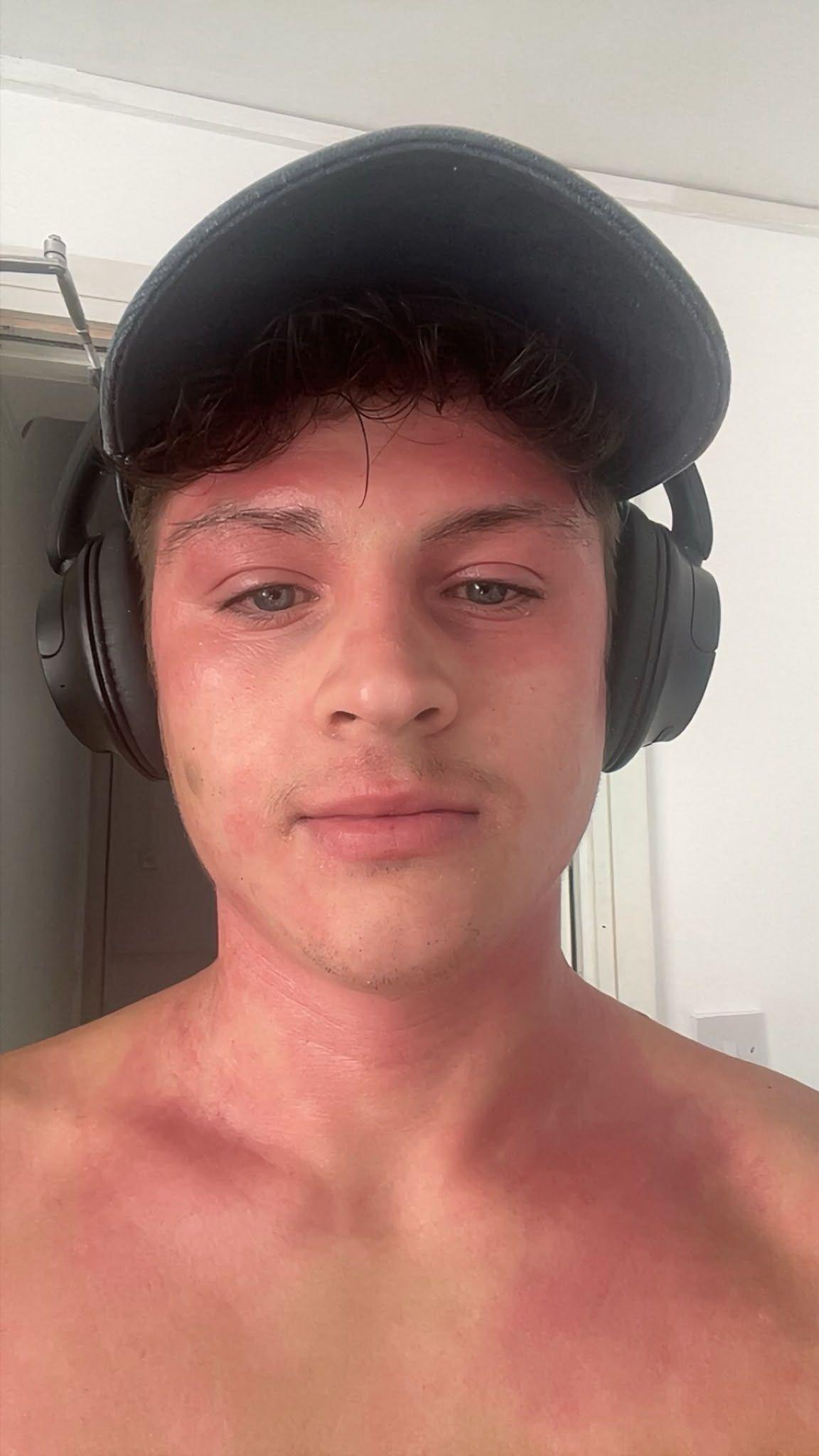 A topless selfie of a young man wearing a black cap and headphones. There are blotchy red patches on his face, neck and chest.