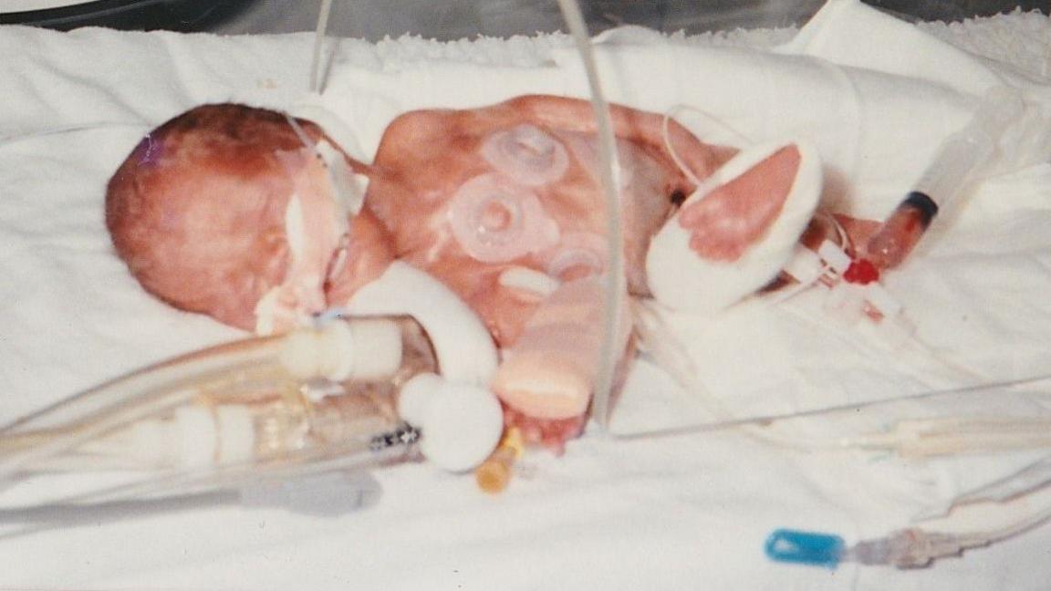 A premature baby in a hospital unit - a picture taken in 1989.