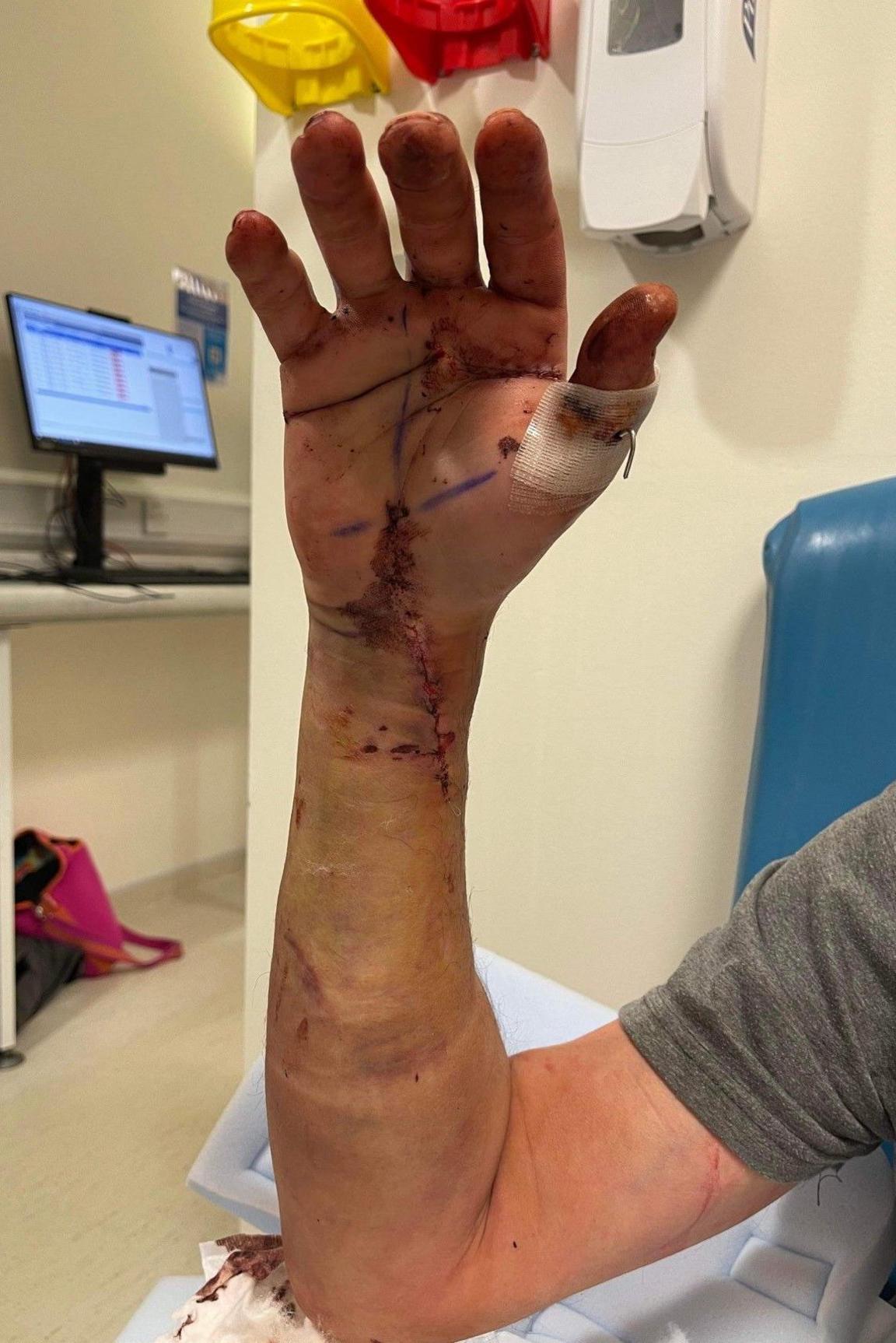 A man in a hospital room holds up his arm and hand, which has swollen fingers and is covered in dried blood. There are purple pen marks across his hand.