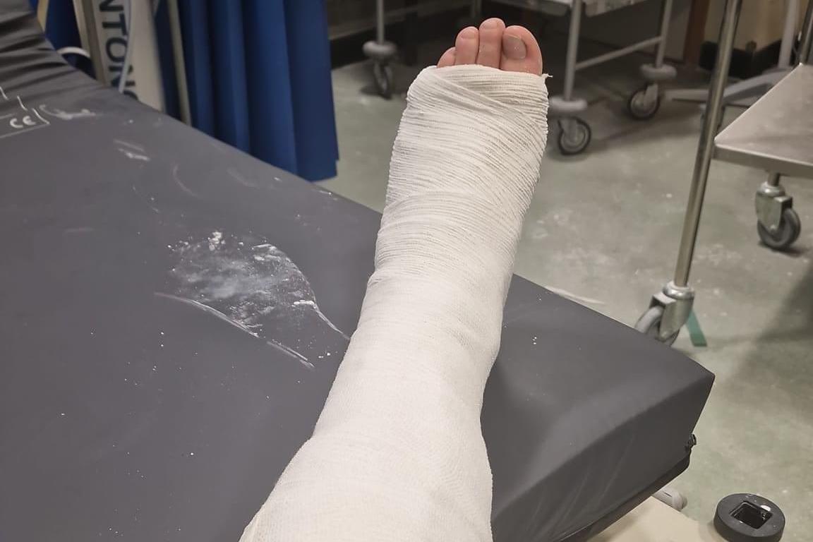 A leg in a cast