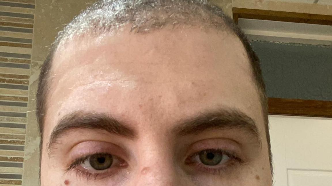 Close up photo of Kyle, shortly after starting on finasteride