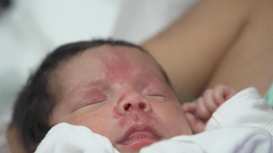A close up of baby Juan David after his rescue, his eyes are closed and minor injuries can be seen on his face.  