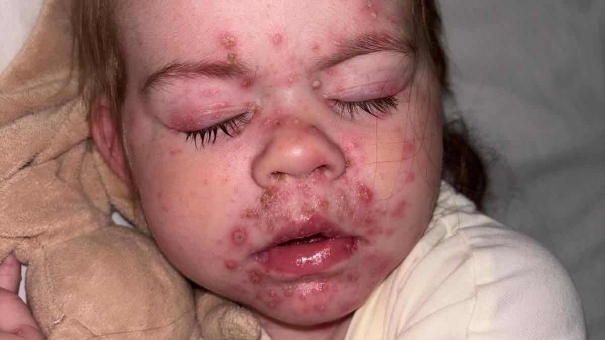 Baby Mia had a severe rash, with chickpox spots around her mouth and on her eyelids