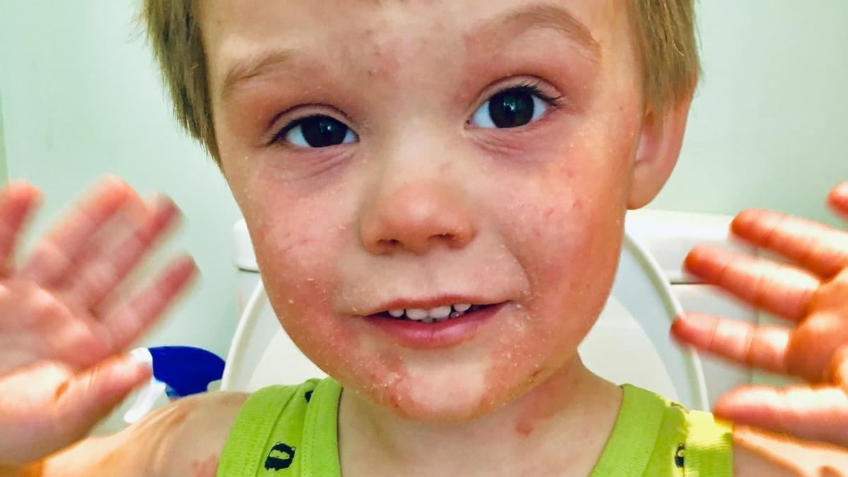 A young Yann Jennings wearing a green vest covered in hives from his allergies. 