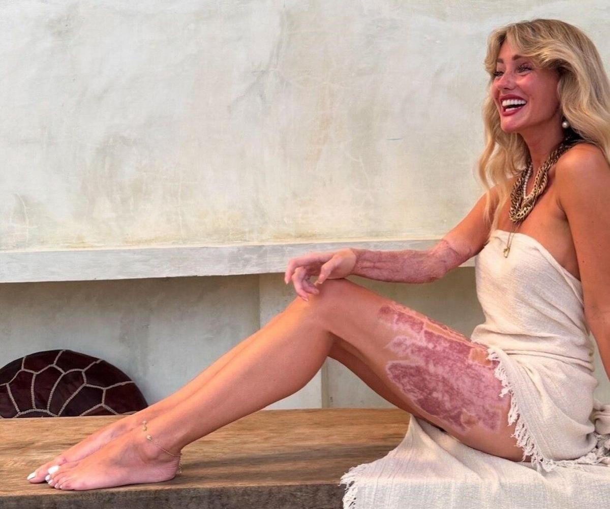 Charlene sits with her legs in front of her. She has wavy blonde hair and a white dress. Her lower right arm shows evidence of a skin graft, as does her outer left thigh. She wears a strapless white dress and necklaces.