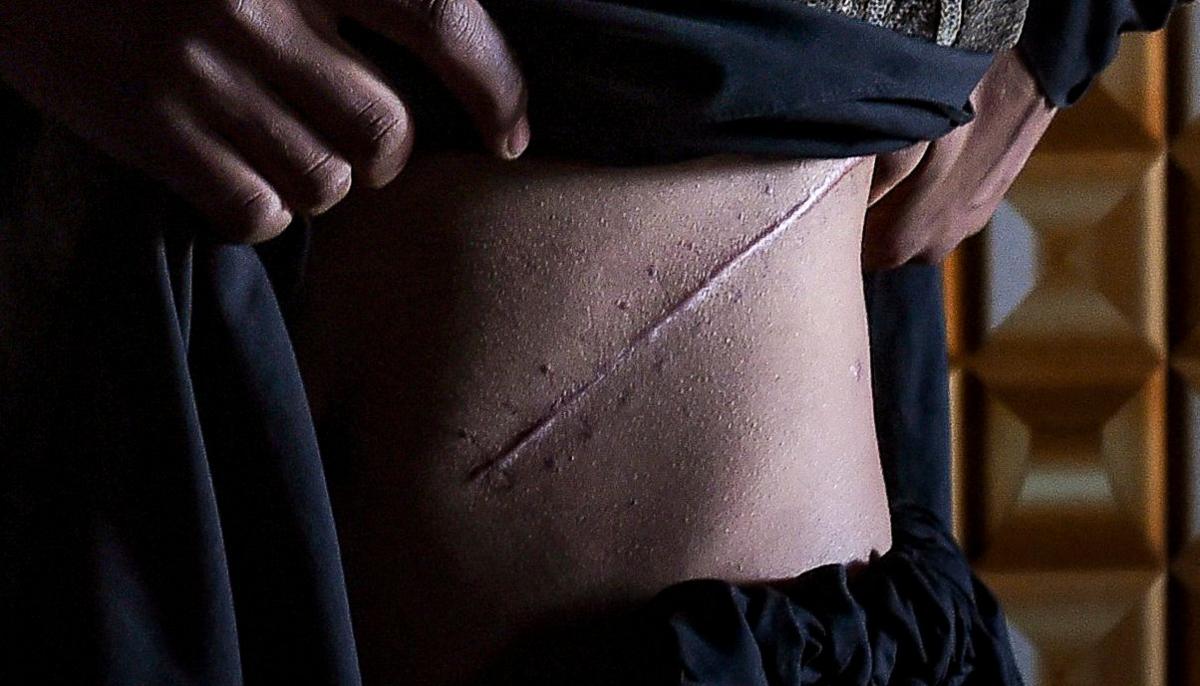 Close up of man's torso as he lifts his clothing to revealing a diagonal scar, that runs from the centre of his stomach to his side. He was photographed in Afghanistan in 2022, Getty reports that he sold his kidney in an attempt to save his family from starvation.