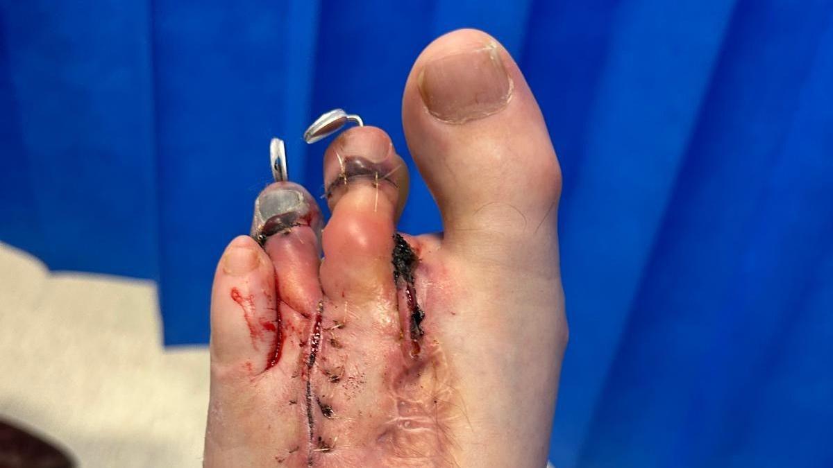 A left foot following surgery, with a disformed big toe, a toe missing and two other toes pinned, with scares running down the foot.