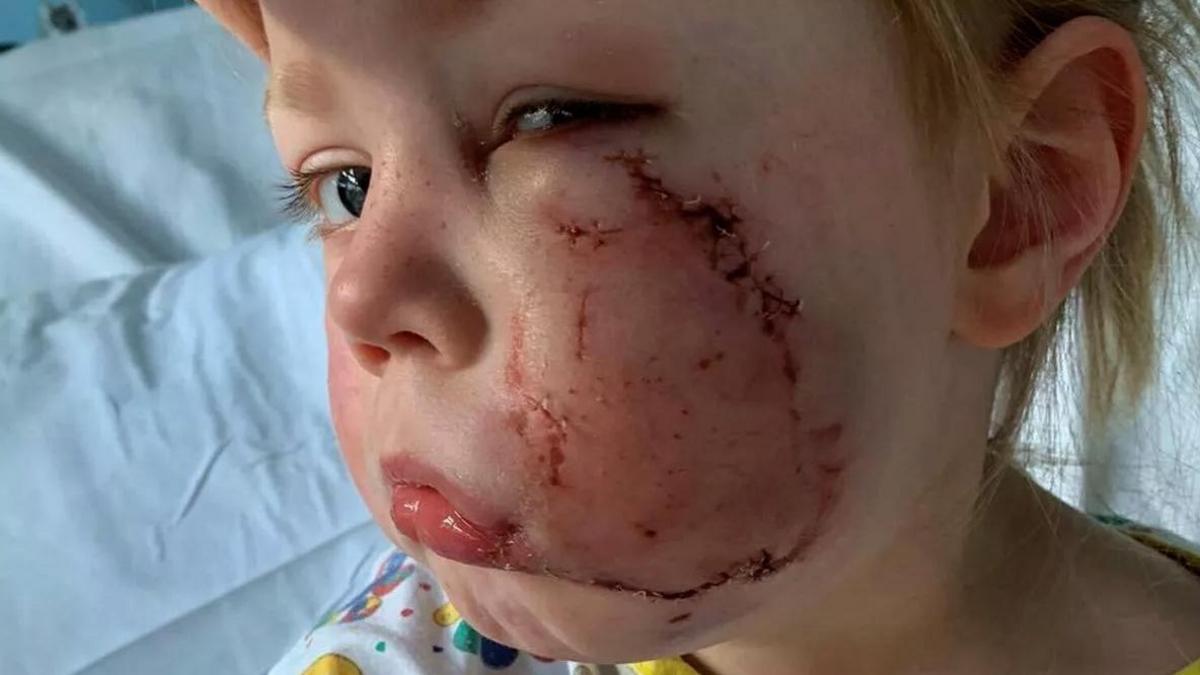 Luna-Ann needed 40 stitches in hospital