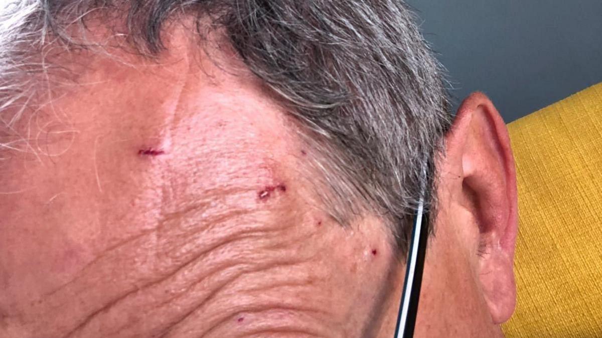 Close-up of a grey-haired man with cuts on his forehead