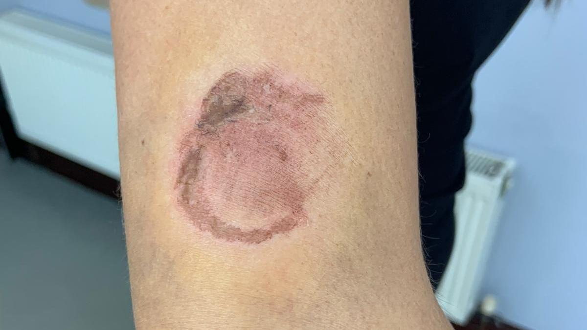 PC Coates's arm, which has a purple bite-shaped scar on it. There is bruising around it.