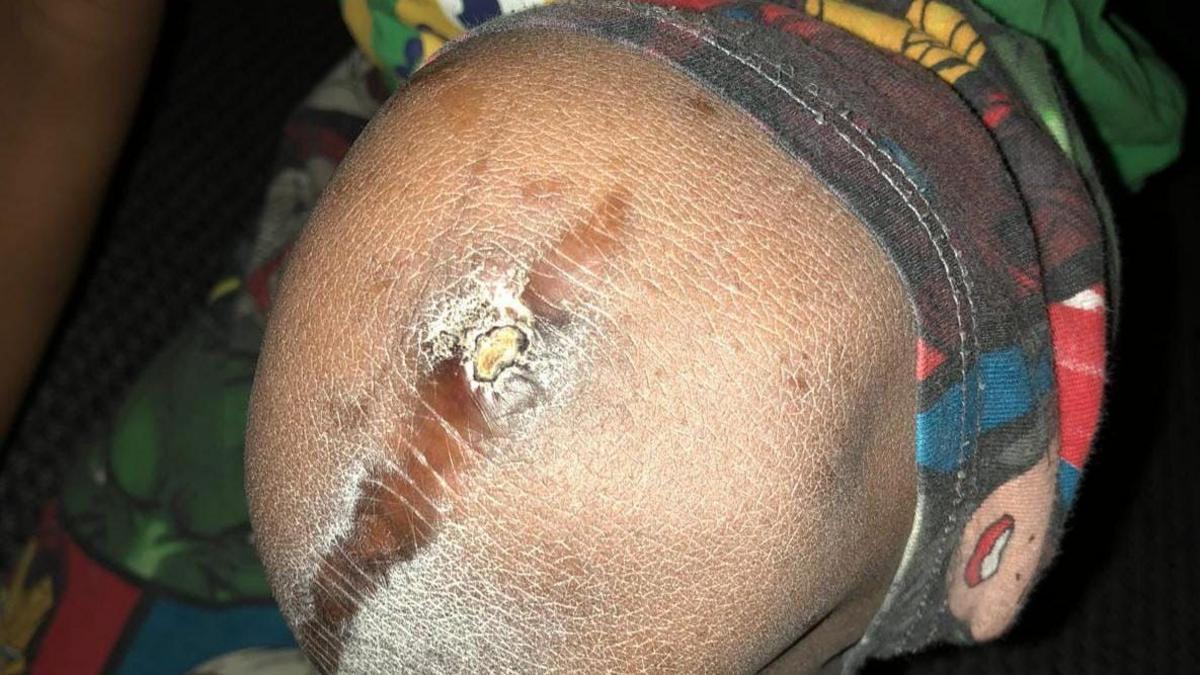 A kneecap with a large scar and patches of dry skin.
