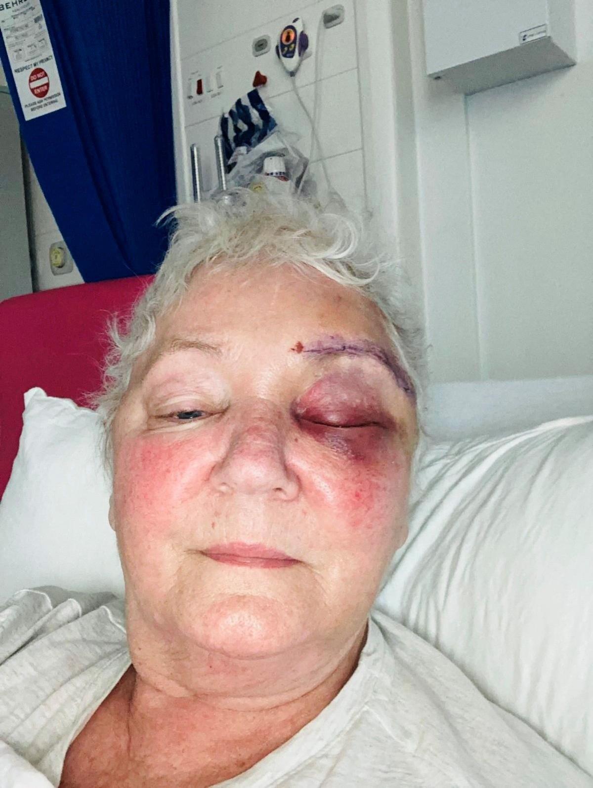 Doreen Adams, woman in hospital bed, with eyebrow scar after surgery and eye appearing bruised.