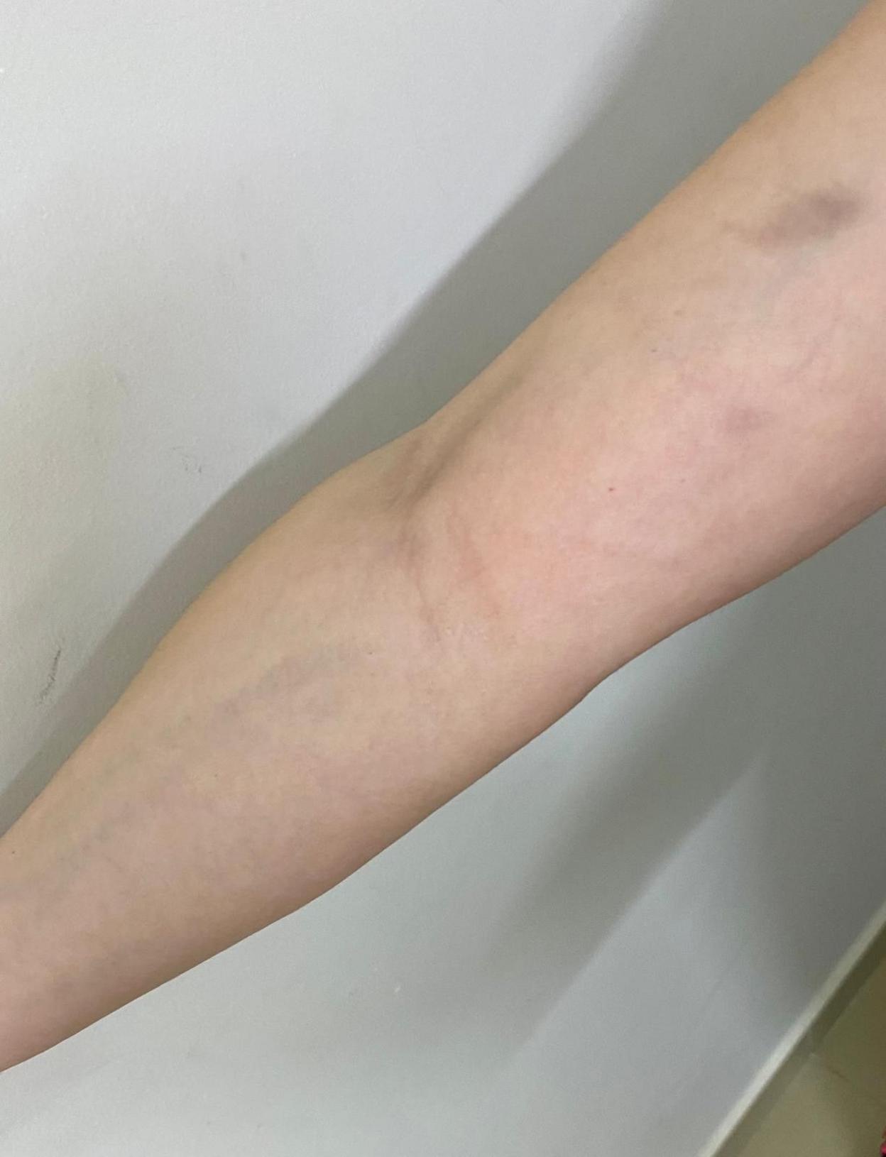 A woman shows the bruises on her right arm