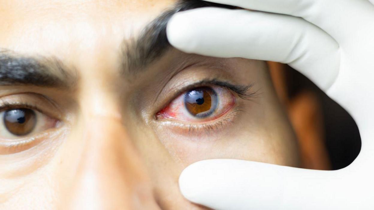 A woman uses a gloved hand to open her bloodshot eye