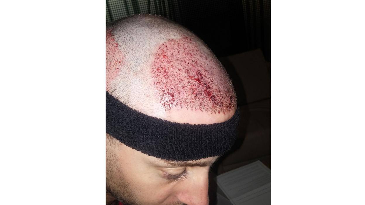 Chris having washed his head for the first time since the operation.