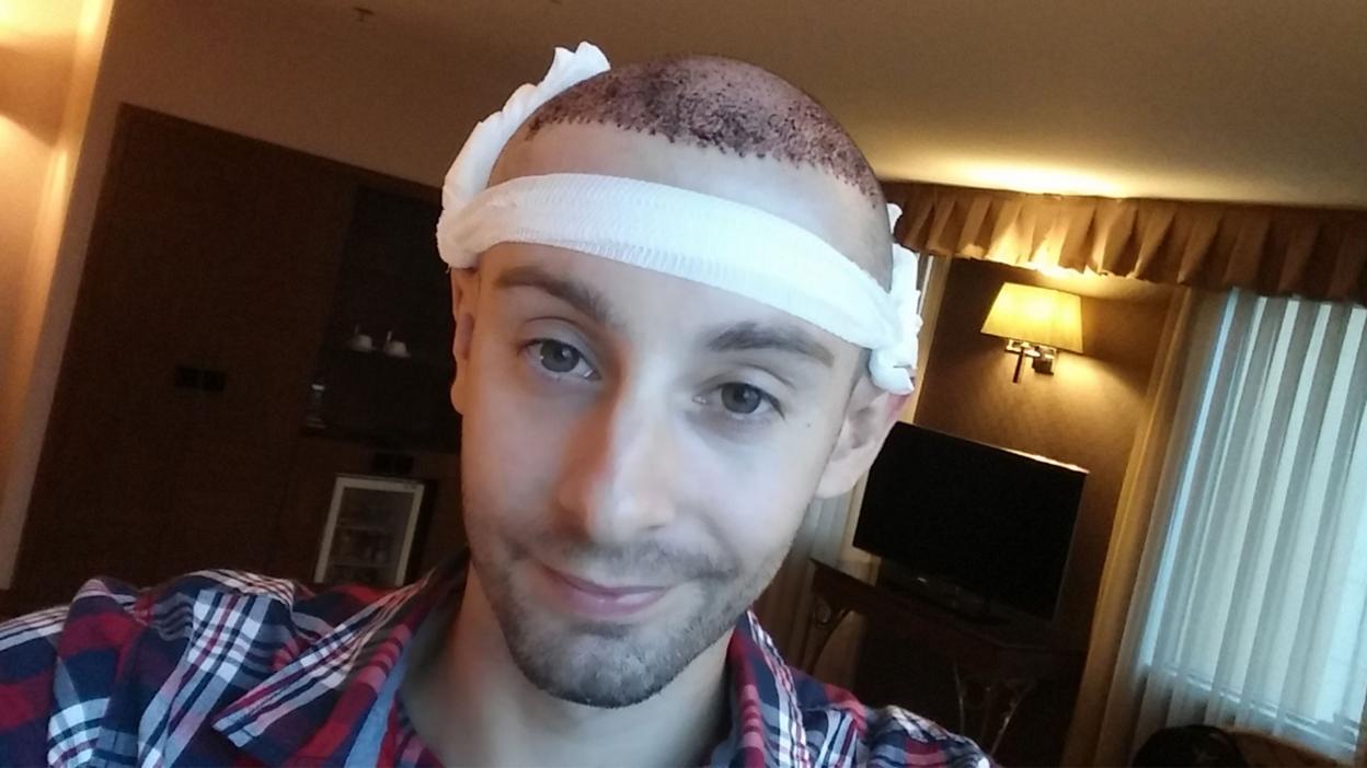 Chris smiles after his hair transplant operation.