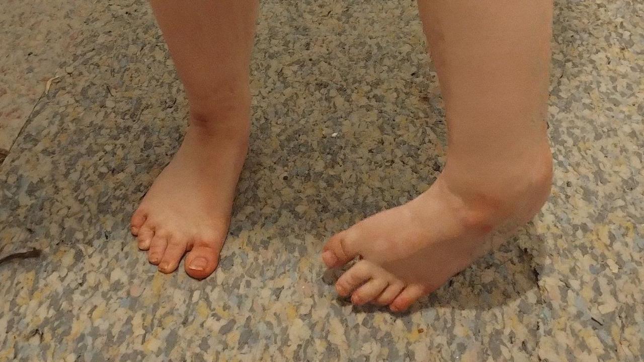 Niamh's two feet and ankles. She is standing, but her left foot is significantly turned inwards.