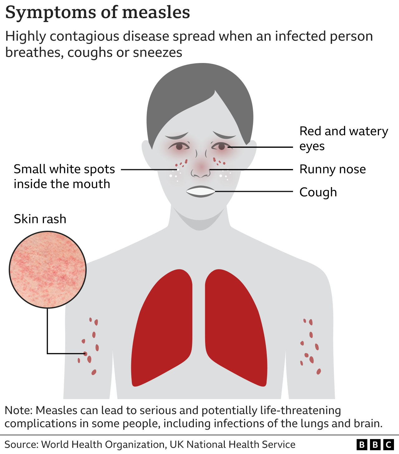 Measles: Why are cases rising and what is the MMR vaccine? - BBC News