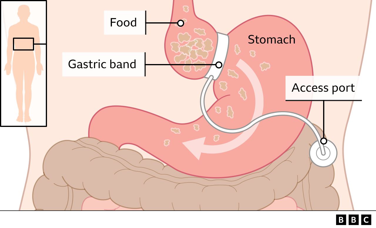 Gastric band