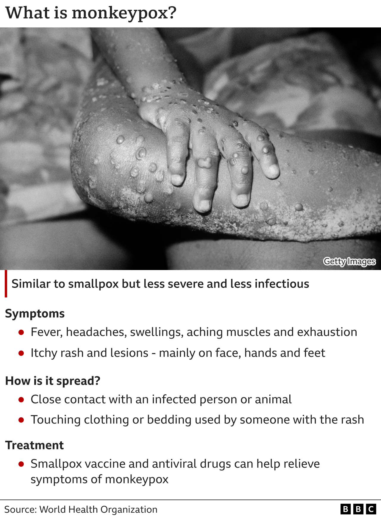 Image shows Monkeypox graphic