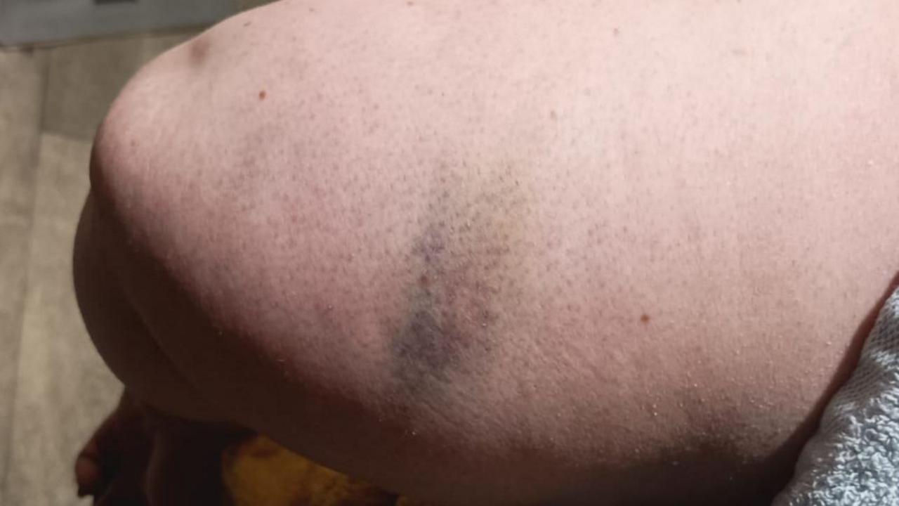 A zoomed picture of Elanor Maxey's upper right arm. Her skin is swollen and has a purple bruise. The bruise is dappled with shades of black, dark red and yellow. 