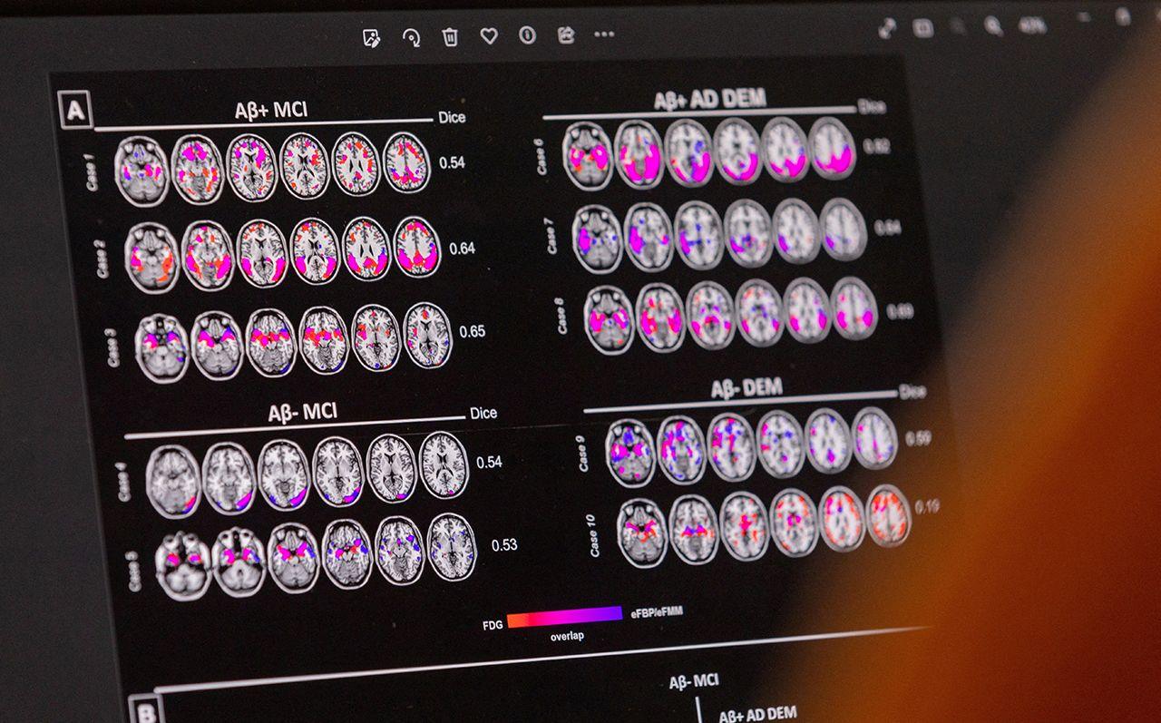 A scan on a computer screen shows Alzheimer's effect on the brain 