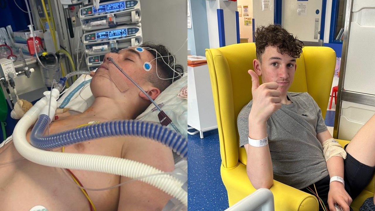 Two photos are side by side. The image to the left is a teenage boy lying in a hospital bed hooked up to a ventilator with a number of wires attached to him. To the right, the boy is sitting in a yellow chair in a hospital room. He is wearing black shorts and a grey t-shirt. He is giving a thumbs up to the camera. 