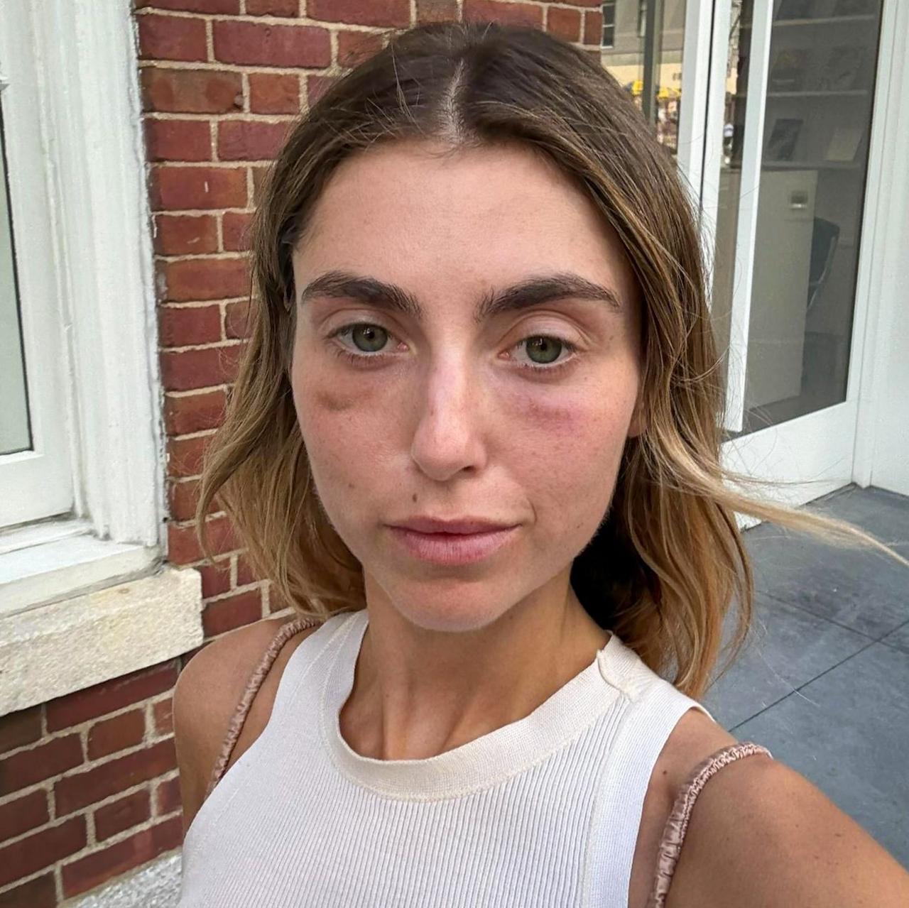 Charlotte Bickley is wearing a white vest. She has long light brown hair and she has dark circles just above her cheek bones under her eyes