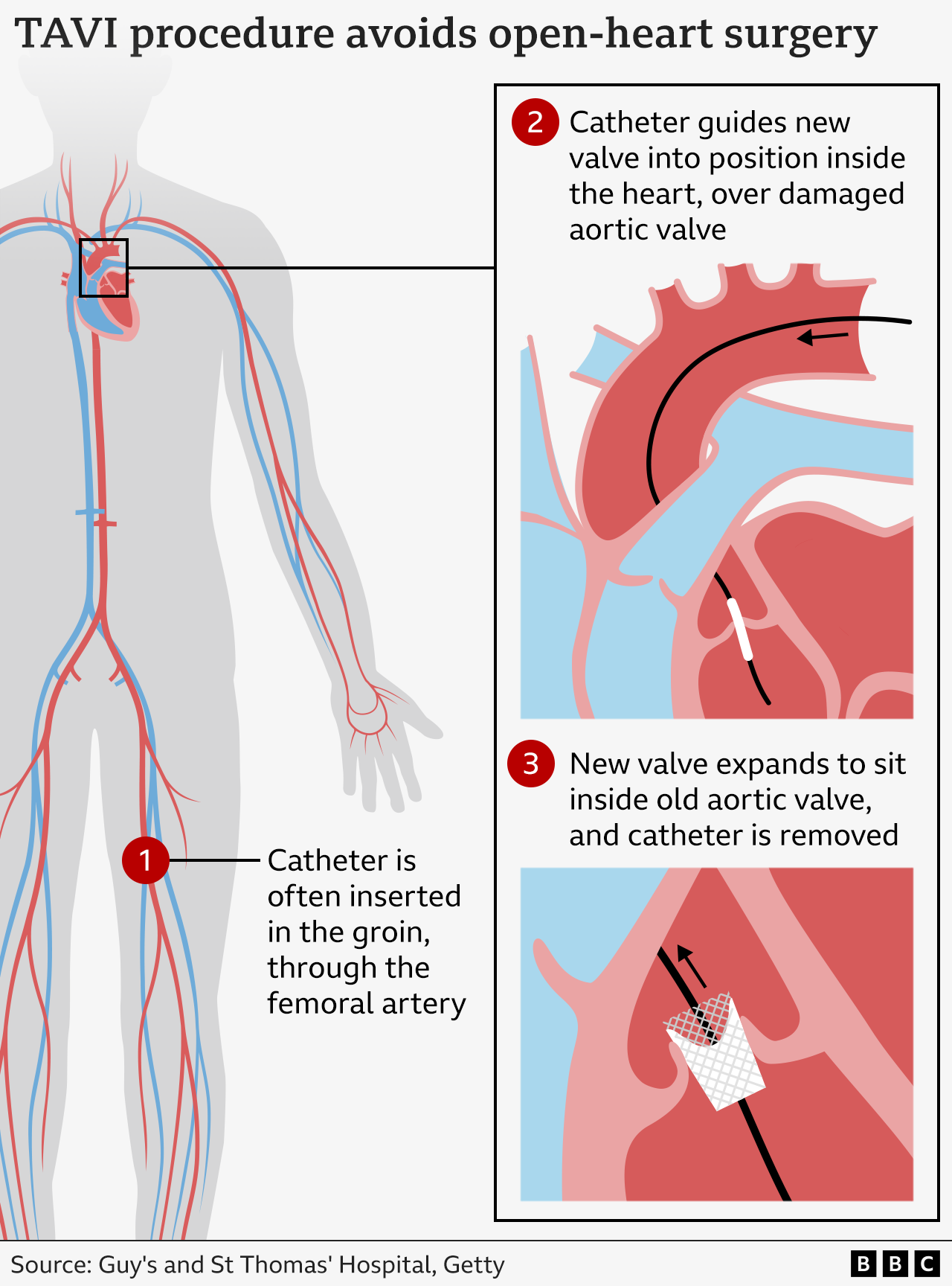 Graphic illustrating how the TAVI procedure works by inserting a new valve via a catheter through a blood vessel.