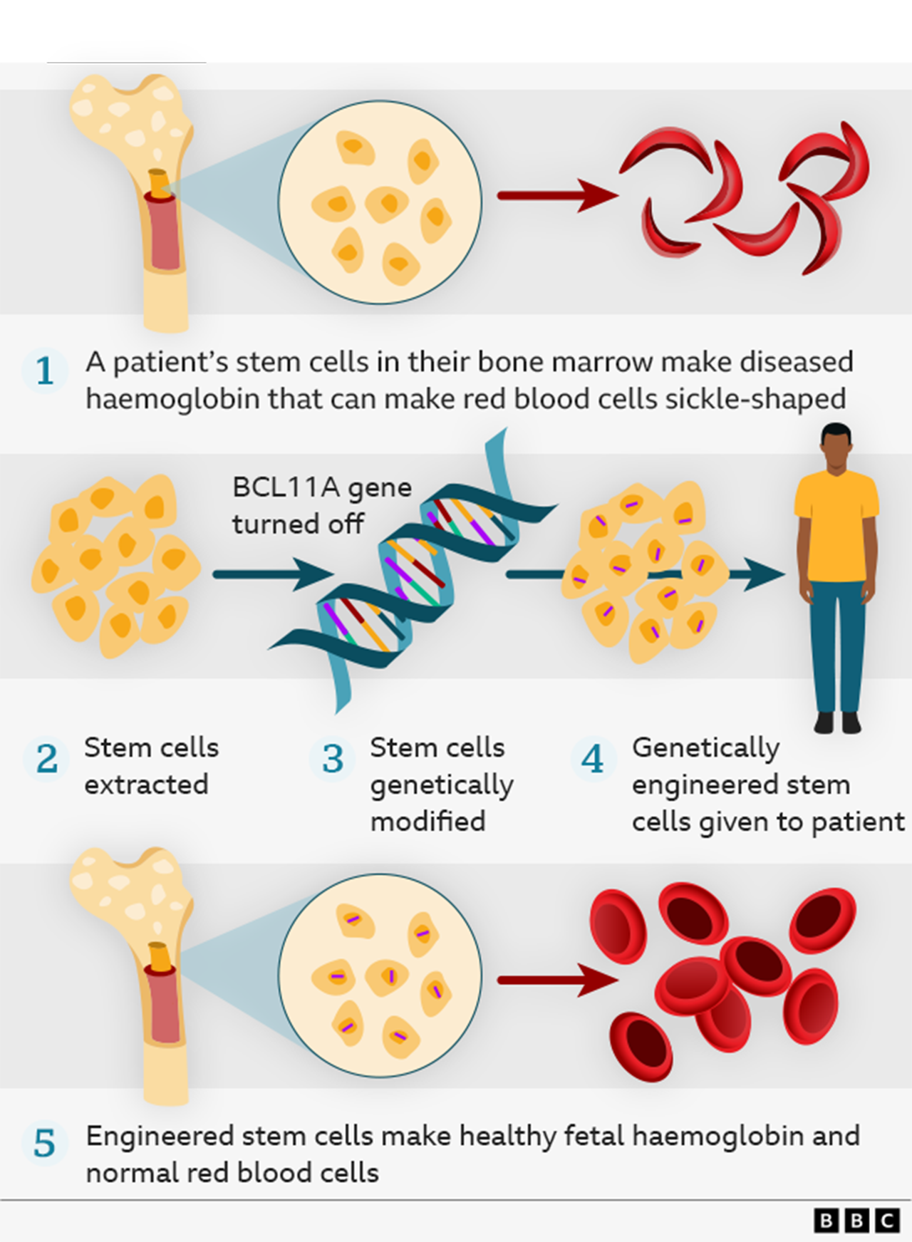 Graphic explaining how the gene therapy works in 5 steps with illustrations. 1) A patient's stem cells in their bone marrow make diseased haemoglobin that can make red blood cells sickle-shaped. 2) Stem cells extracted, and BCL11A gene turned off. 3) Stem cells genetically modified. 4) Genetically engineered stem cells given to patient. 5) Engineered stem cells make healthy fetal haemoglobin and normal red blood cells. 