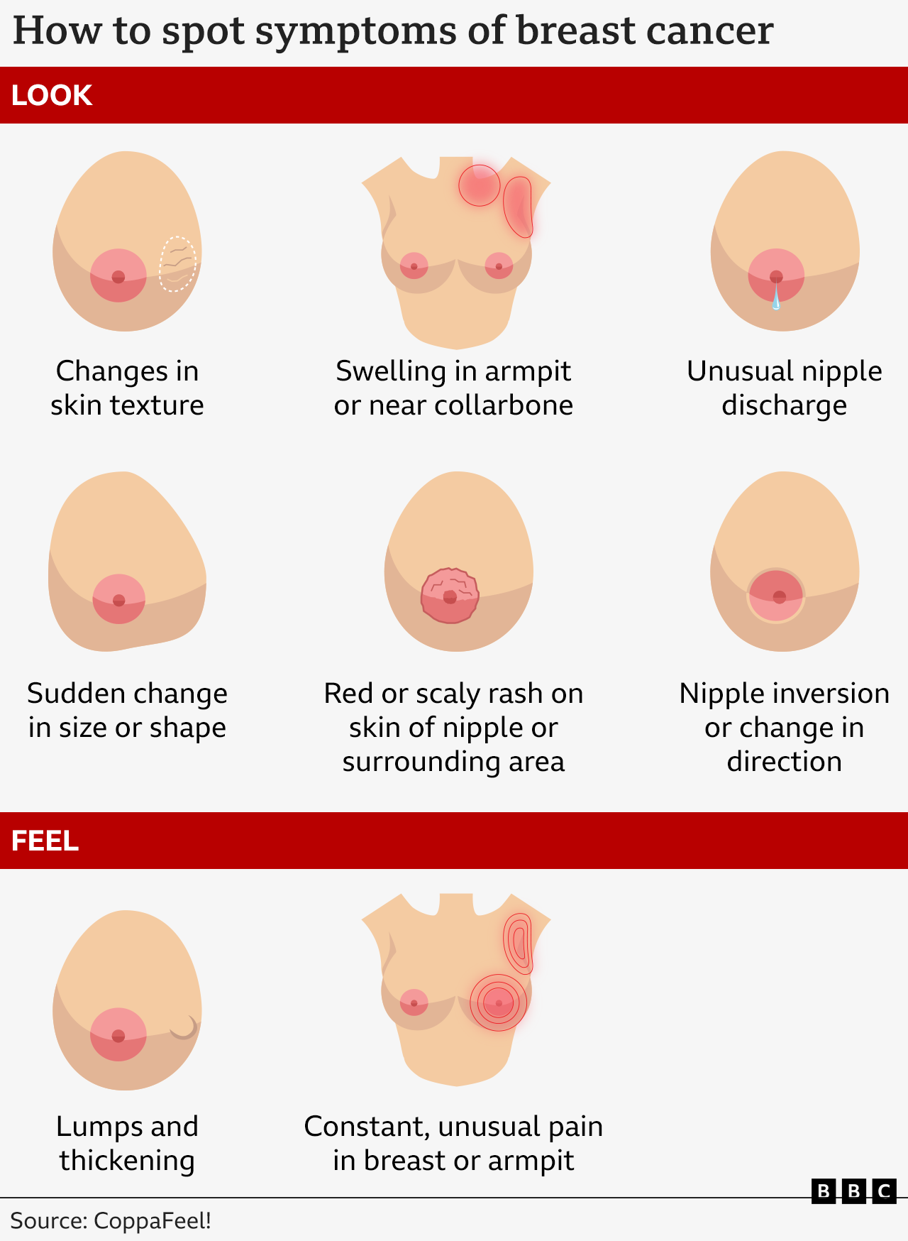 A graphic shows how to spot the symptoms of breast cancer. These include, looking out for lumps and thickening, pain or swelling in the breast or armpit, changes in skin texture, unusual nipple discharge, sudden change in size or shape, red or scaly rash on the skin of the nipple or surrounding area and nipple inversion.