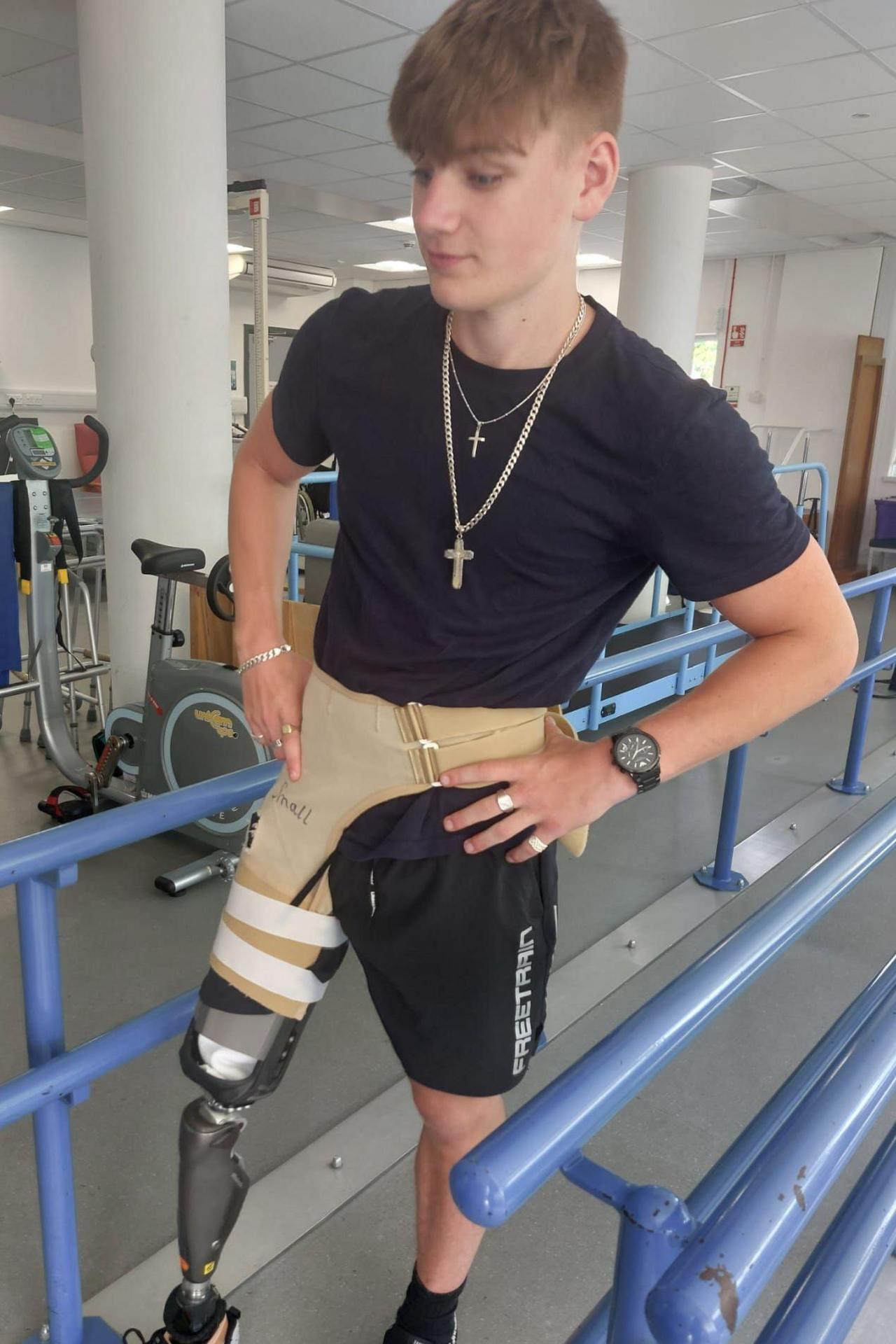 Oliver showing his prosthetic leg