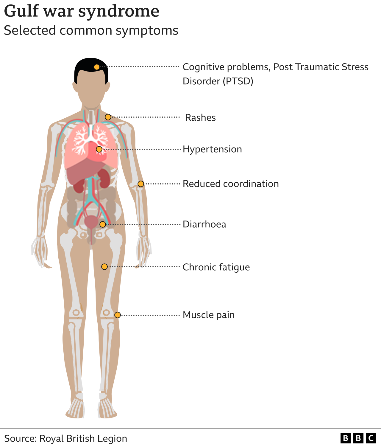 Common symptoms of Gulf War syndrome