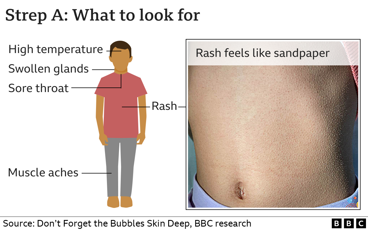 Graphic showing Strep A symptoms to look out for: fever, rash that feels like sandpaper, swollen glands, sore throat and muscle aches