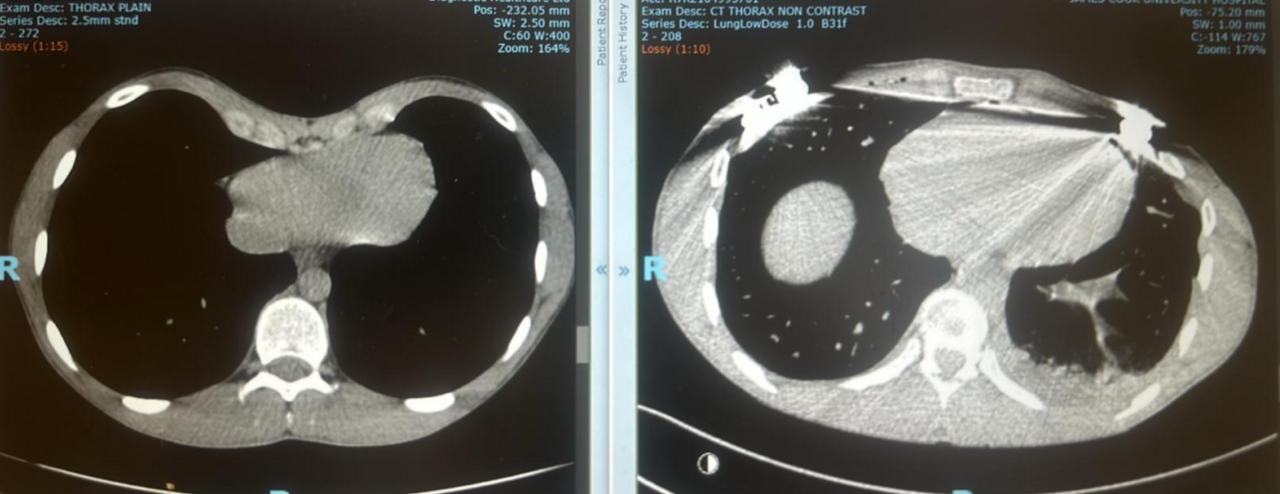 Louis's chest scans before and after the operation