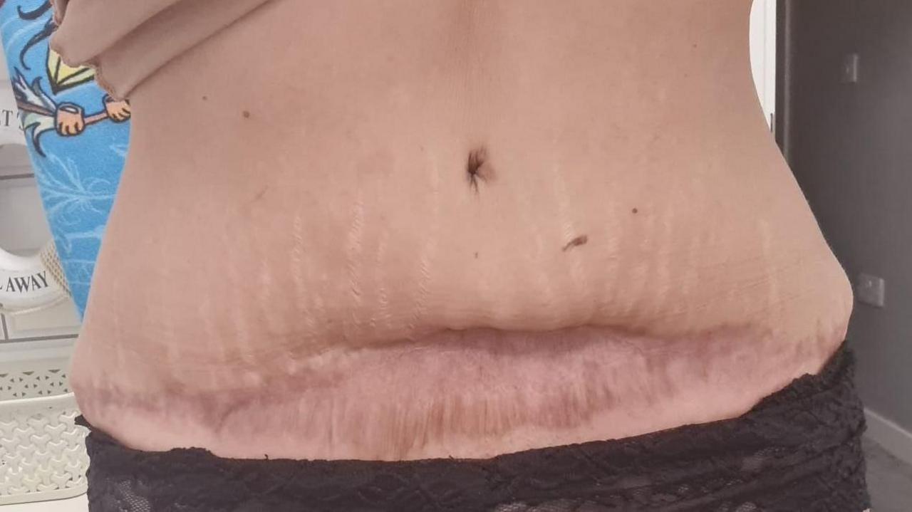 A woman shows a deep, dark pink scar that stretches across her stomach.