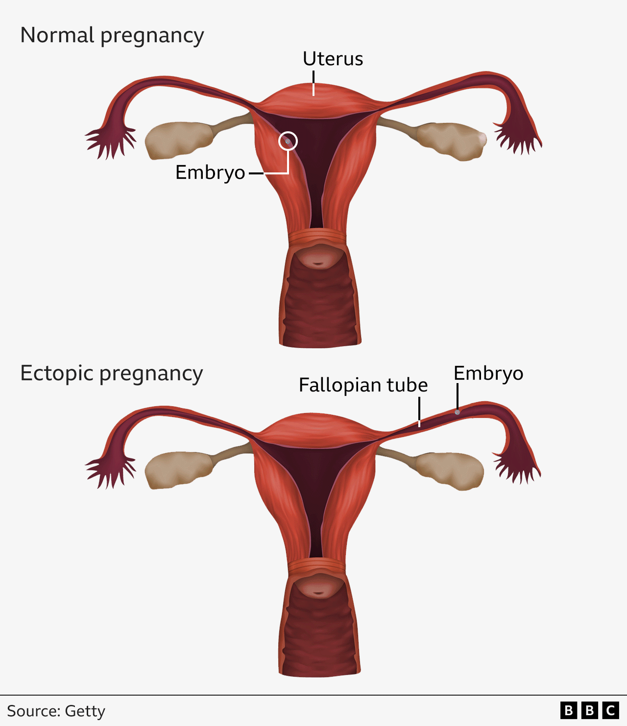 Graphic comparing diagram of normal pregnancy to diagram of ectopic pregnancy. In the first the embryo is pictured inside the womb. In the second it is pictured in the fallopian tube